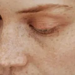 Primer plano de un ojo cerrado y nariz de una persona con muchas pecas, demostrando que las pecas son hereditarias.