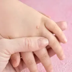 Manos de un niño con verrugas en la palma y dedos. Una mano adulta sostiene suavemente la mano del niño.