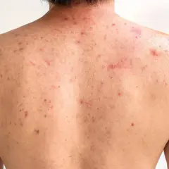 Espalda de adolescente con granos y marcas de acné, mostrando la piel con varias lesiones inflamatorias y cicatrices.