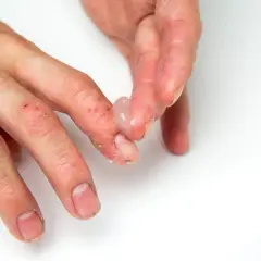 Manos con dermatitis, piel seca y agrietada. Se aplica un gel transparente como parte del tratamiento.
