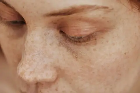 Primer plano de un ojo cerrado y nariz de una persona con muchas pecas, demostrando que las pecas son hereditarias.