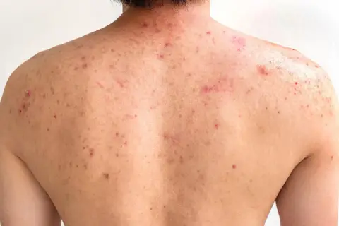 Espalda de adolescente con granos y marcas de acné, mostrando la piel con varias lesiones inflamatorias y cicatrices.