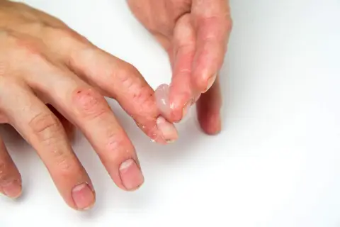 Manos con dermatitis, piel seca y agrietada. Se aplica un gel transparente como parte del tratamiento.