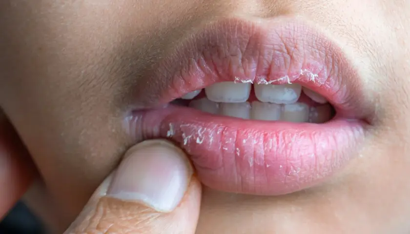 Labios agrietados y descamados, con piel levantada. ¿Por qué se resecan los labios si tomo mucha agua?