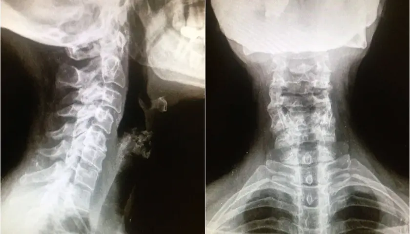 Síntomas de artrosis cervical grave: identifica el dolor y la debilidad