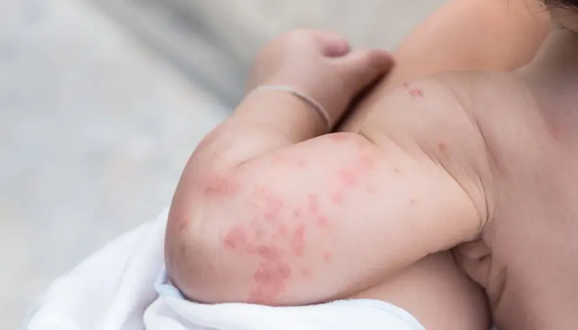 Brazos de un bebé con urticaria, mostrando ronchas rojas y elevadas.