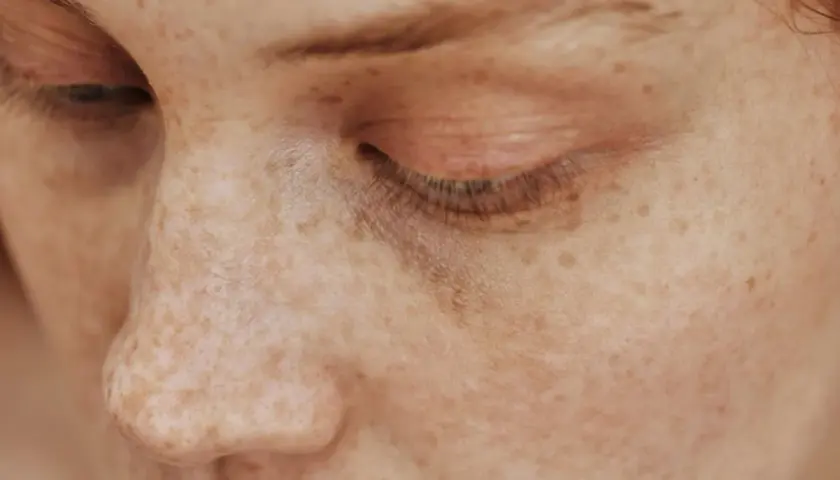 Primer plano de un ojo cerrado y nariz de una persona con muchas pecas, demostrando que las pecas son hereditarias.
