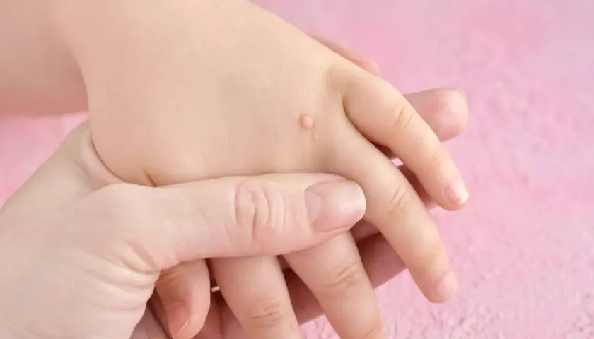 Manos de un niño con verrugas en la palma y dedos. Una mano adulta sostiene suavemente la mano del niño.