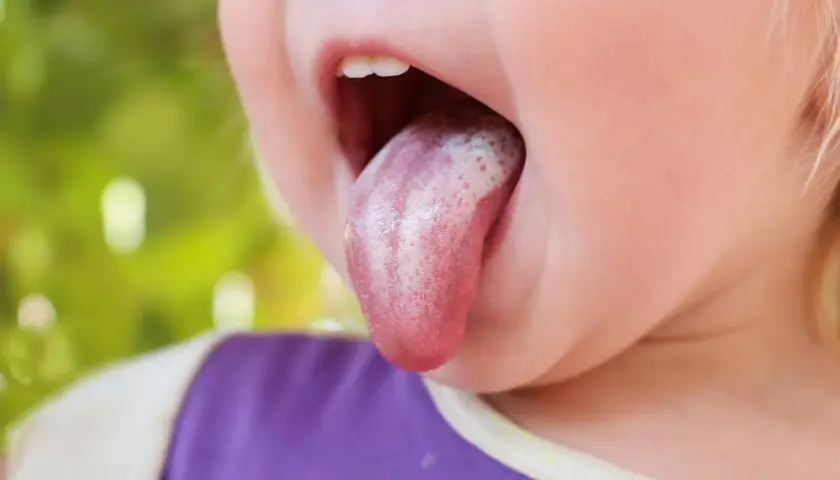 Boca de un niño de 2 años con lengua afuera, mostrando manchas blancas que podrían ser hongos.