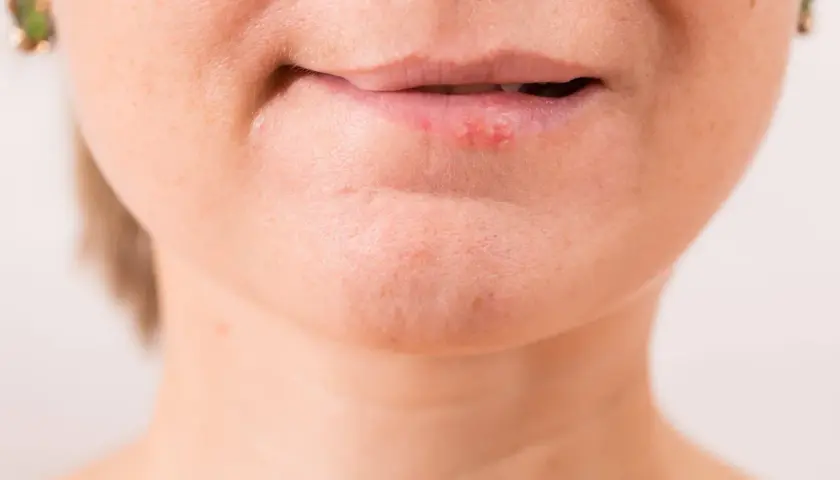Labios con herpes, posiblemente por exposición al sol.
