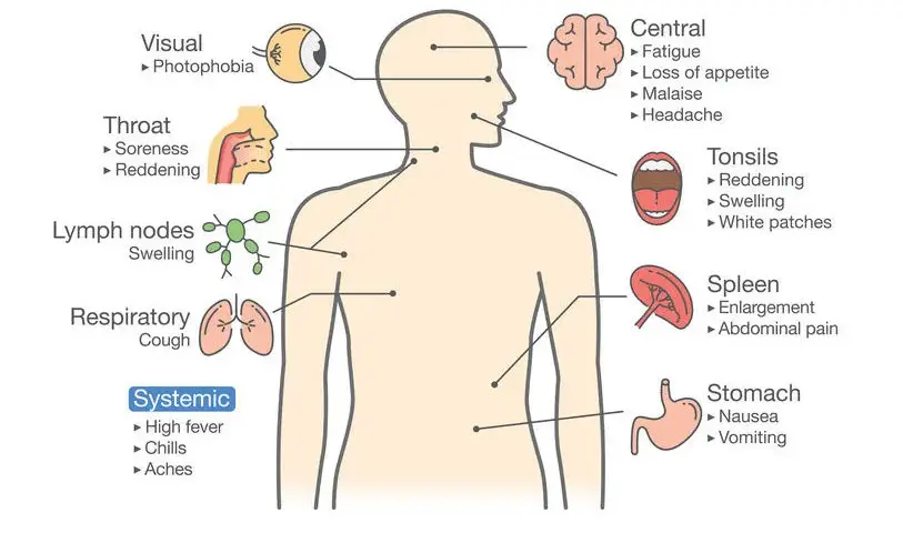 Síntoma de la mononucleosis: identifica los signos y evita complicaciones