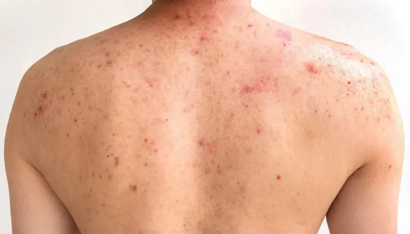 Espalda de adolescente con granos y marcas de acné, mostrando la piel con varias lesiones inflamatorias y cicatrices.