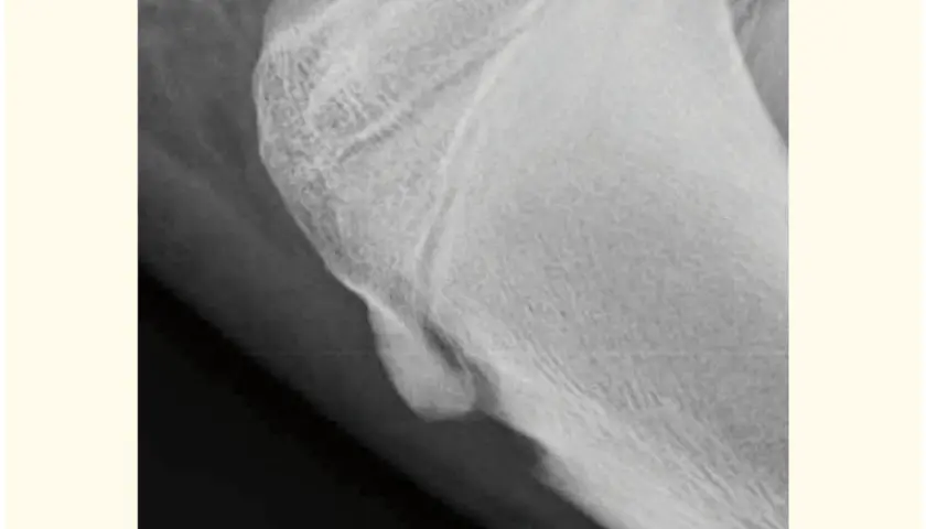 Radiografía de rodilla que muestra fragmentación de la apófisis tibial derecha, indicativo de Osgood-Schlatter.