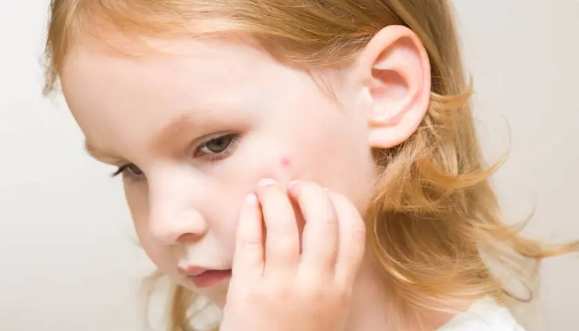 Niña con una pequeña lesión roja en la mejilla, posible signo de impétigo en niños.