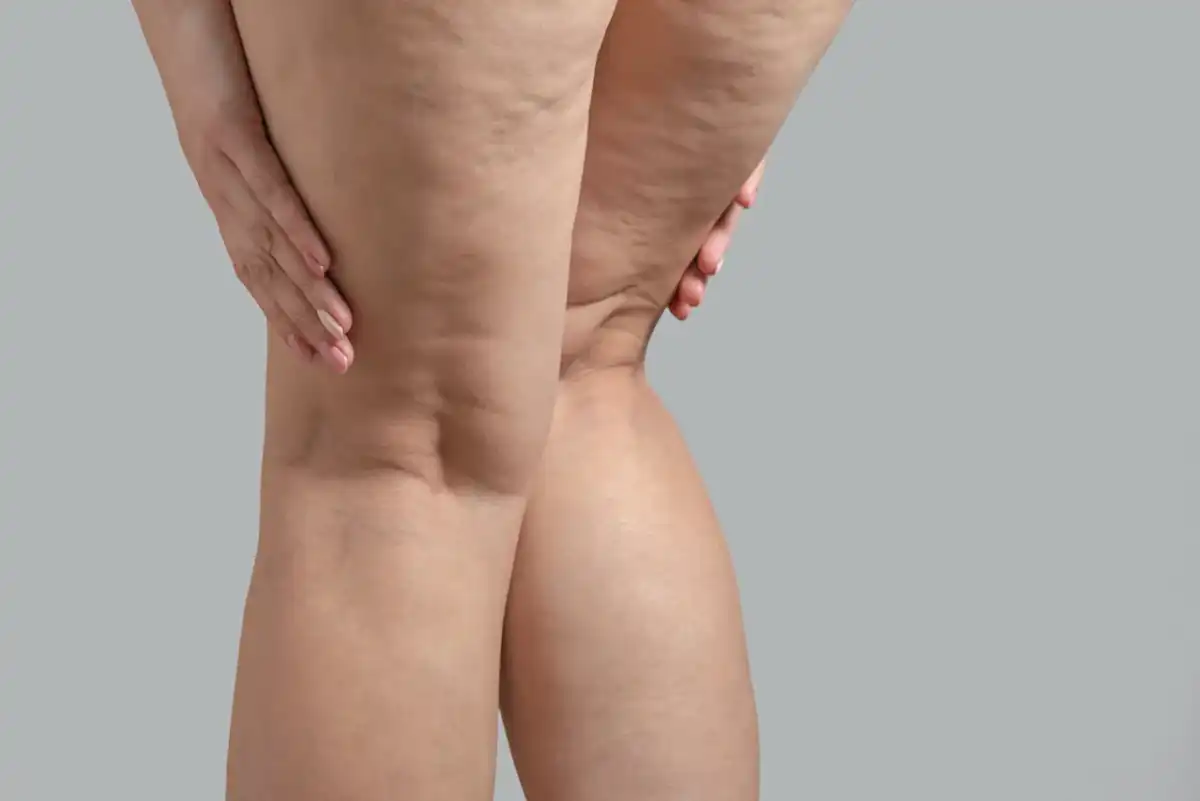 Celulitis edematosa - qué es y cómo reconocerla