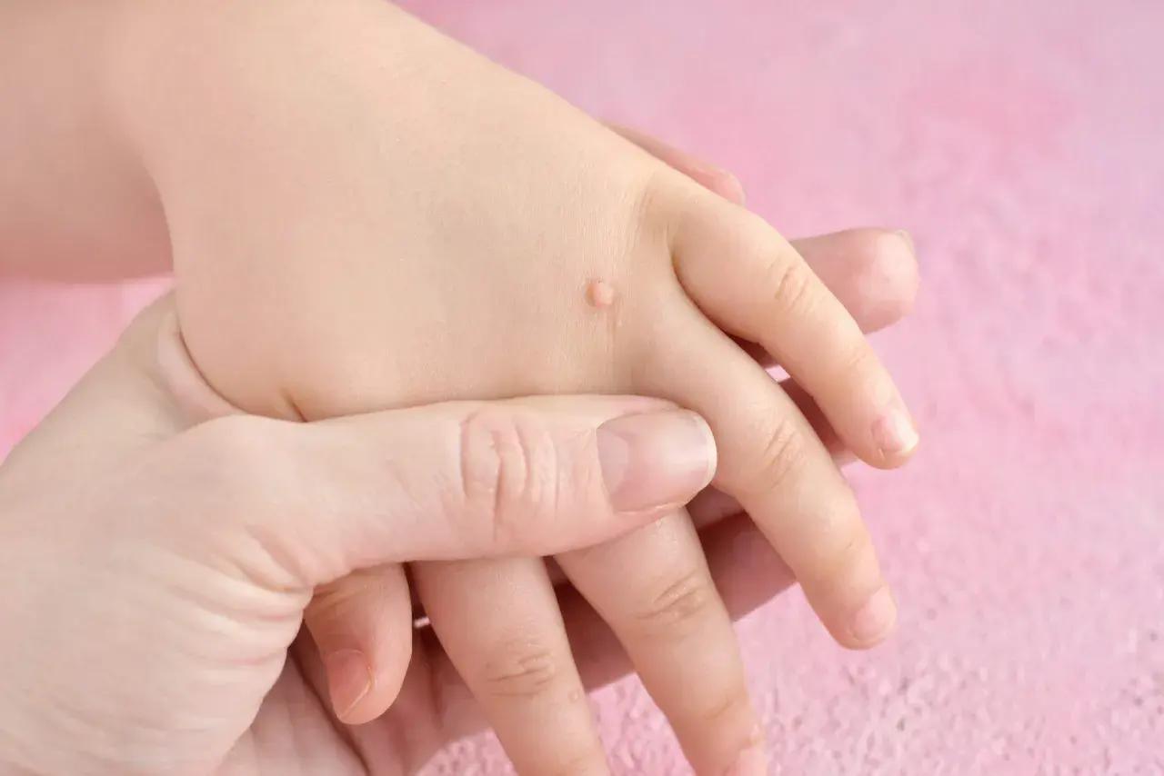 Manos de un niño con verrugas en la palma y dedos. Una mano adulta sostiene suavemente la mano del niño.