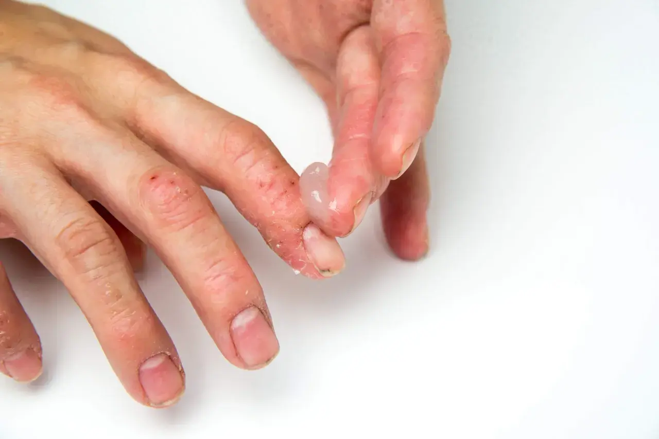 Manos con dermatitis, piel seca y agrietada. Se aplica un gel transparente como parte del tratamiento.