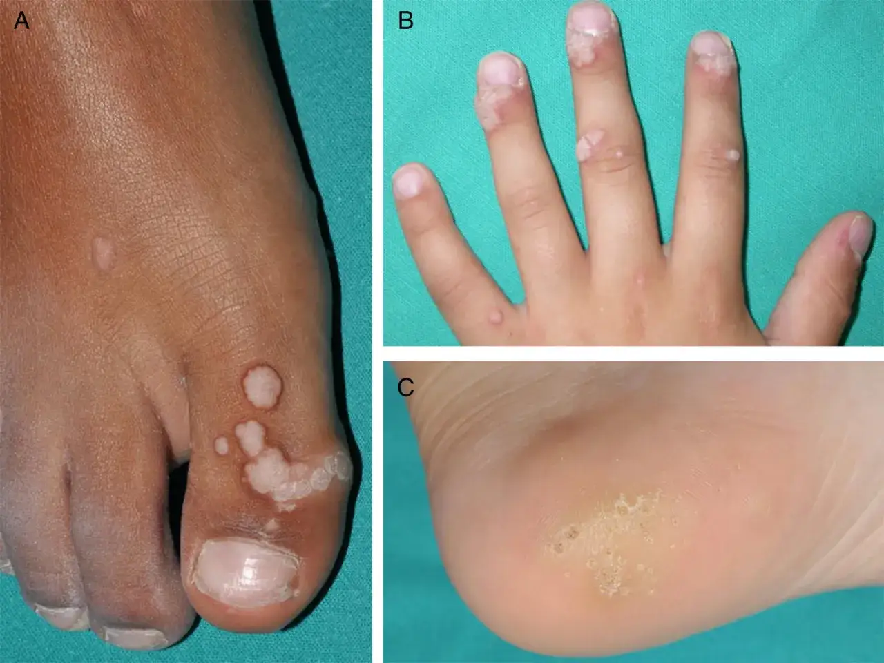 A, B y C muestran verrugas en niños: en el pie, dedos y talón.