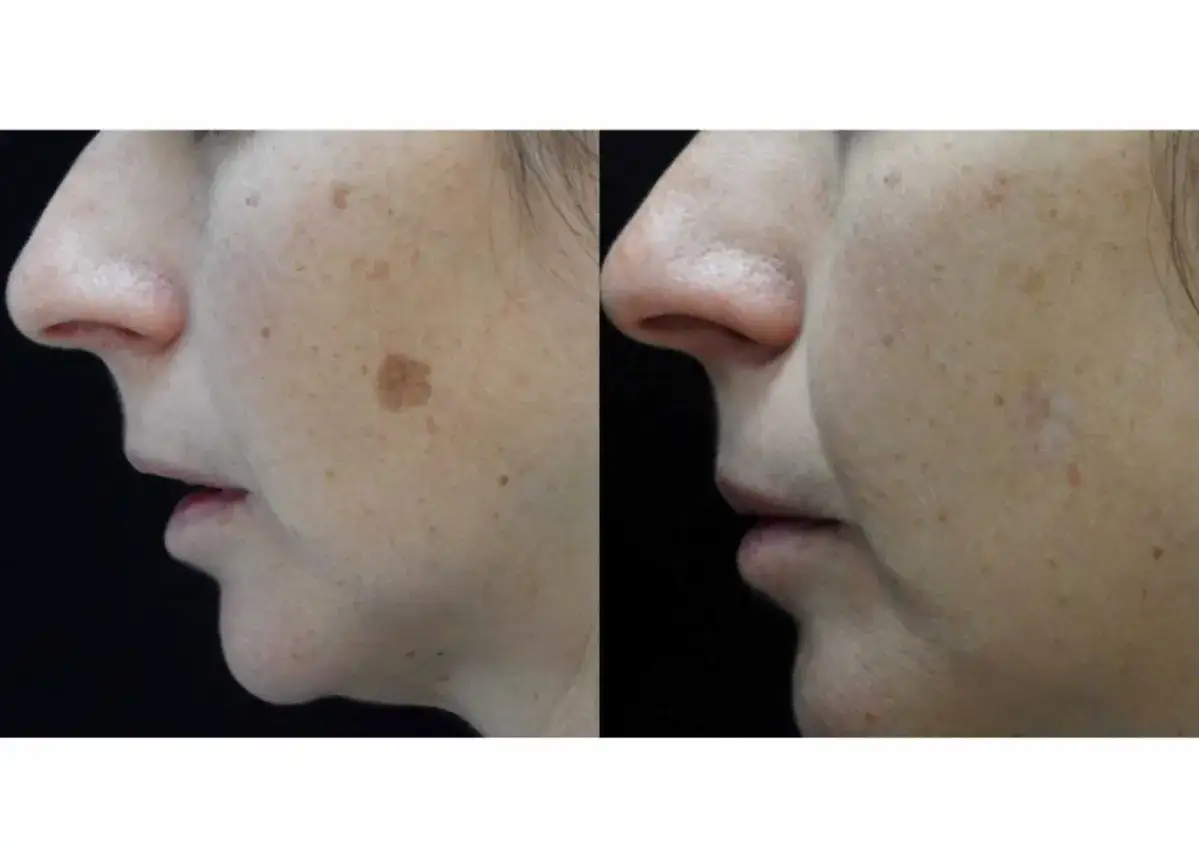 Comparación de piel: antes y después de un tratamiento. Las pecas son hereditarias y se muestran en la mejilla izquierda.