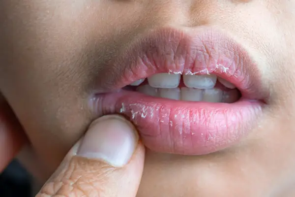 Labios agrietados y descamados, con piel levantada. ¿Por qué se resecan los labios si tomo mucha agua?