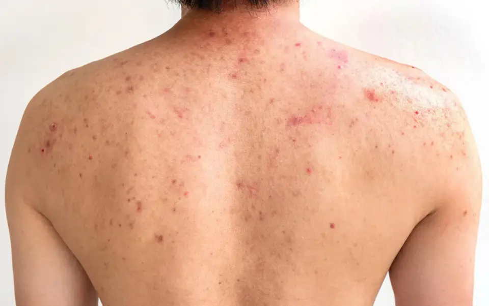 Acné en la espalda en la adolescencia - cómo tratarlo